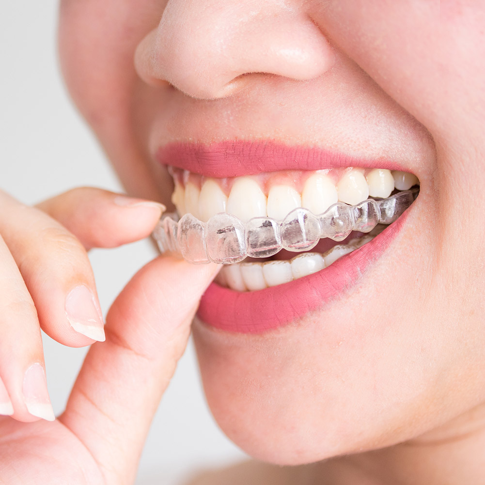 Teeth Whitening For Trays - 2/4pcs Mouth Guard Teeth Protector Guard