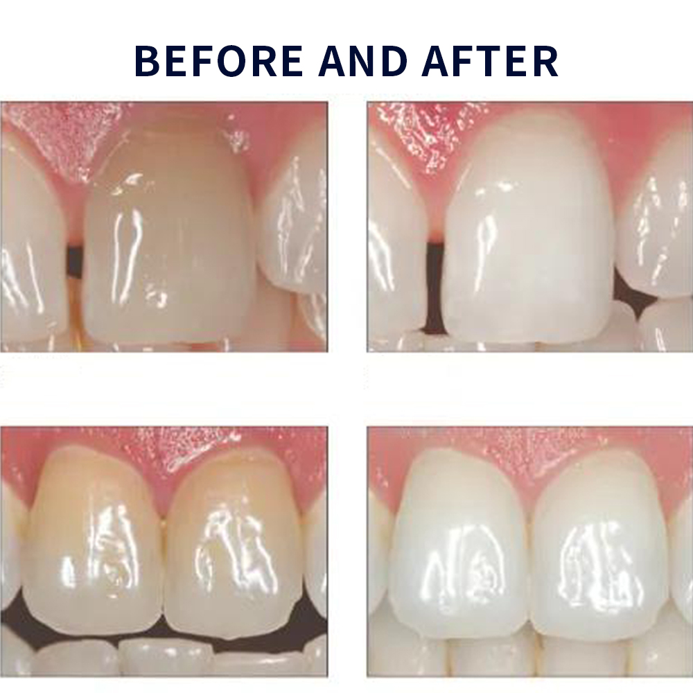 Opalescence Whitening 20% PF 2 – обзор и цена Teeth Whitening Gels Used By Dentists