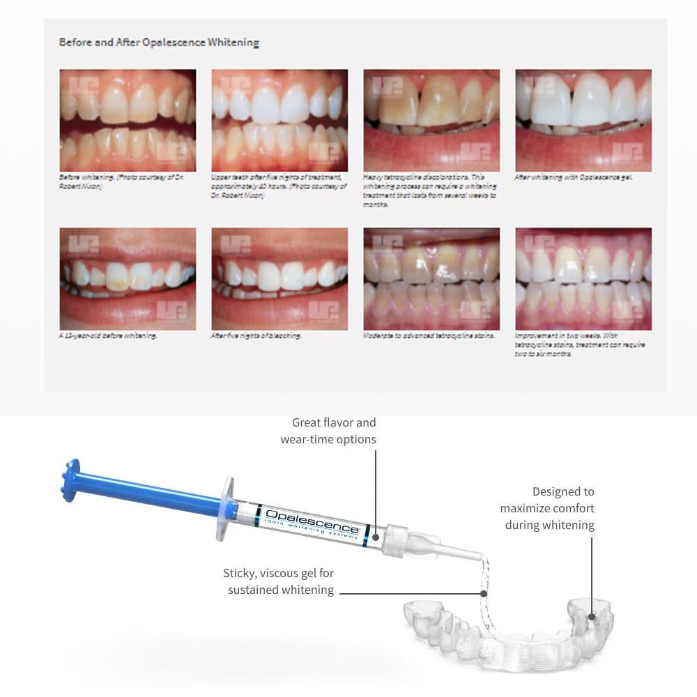 Opalescence Whitening 20% PF 2 – обзор и цена Teeth Whitening Gels Used By Dentists