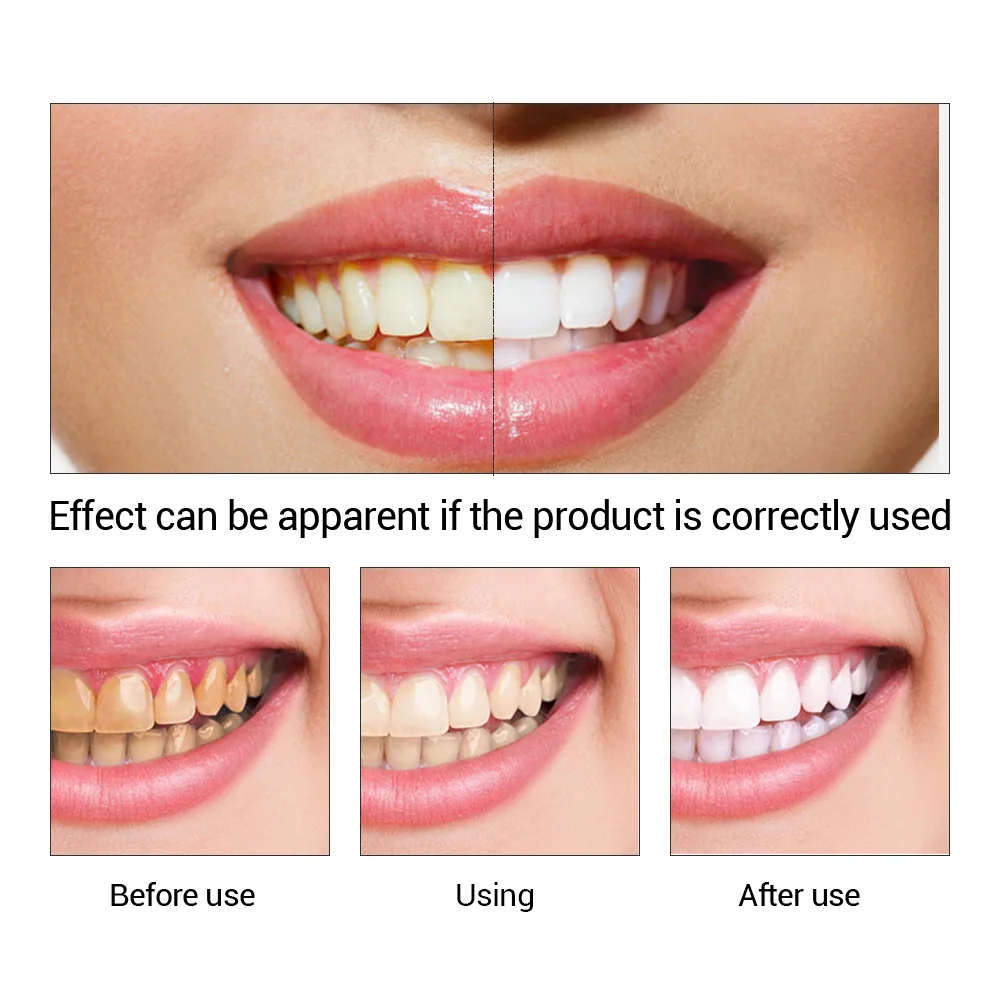 FTEENPLY Teeth Whitening Essen – обзор и цена Teeth Whitening (Bleaching)