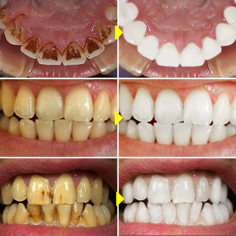 V34 Teeth Whitening Mousse Too – обзор и цена Teeth Whitening Xylitol