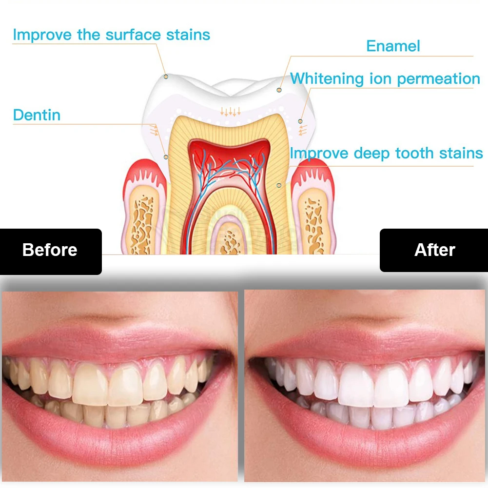Dental Teeth Whitening Kit Min – обзор и цена Teeth Whitening Light Kit